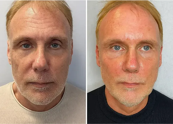 Pack Forge au suif de bœuf– Spécialement pour la peau des hommes matures RONEX