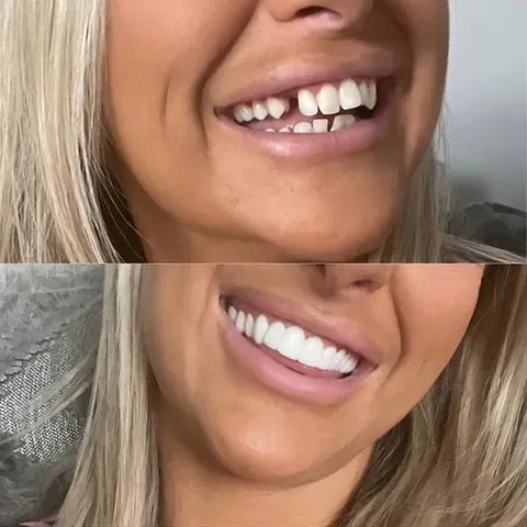 Hushra™ Facettes à clipser