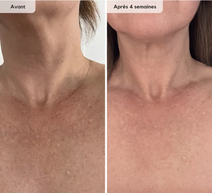 Système LED cou et décolleté