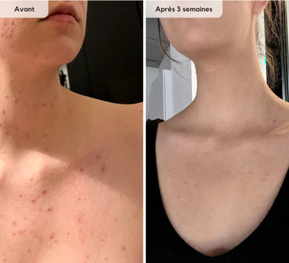 Système LED cou et décolleté