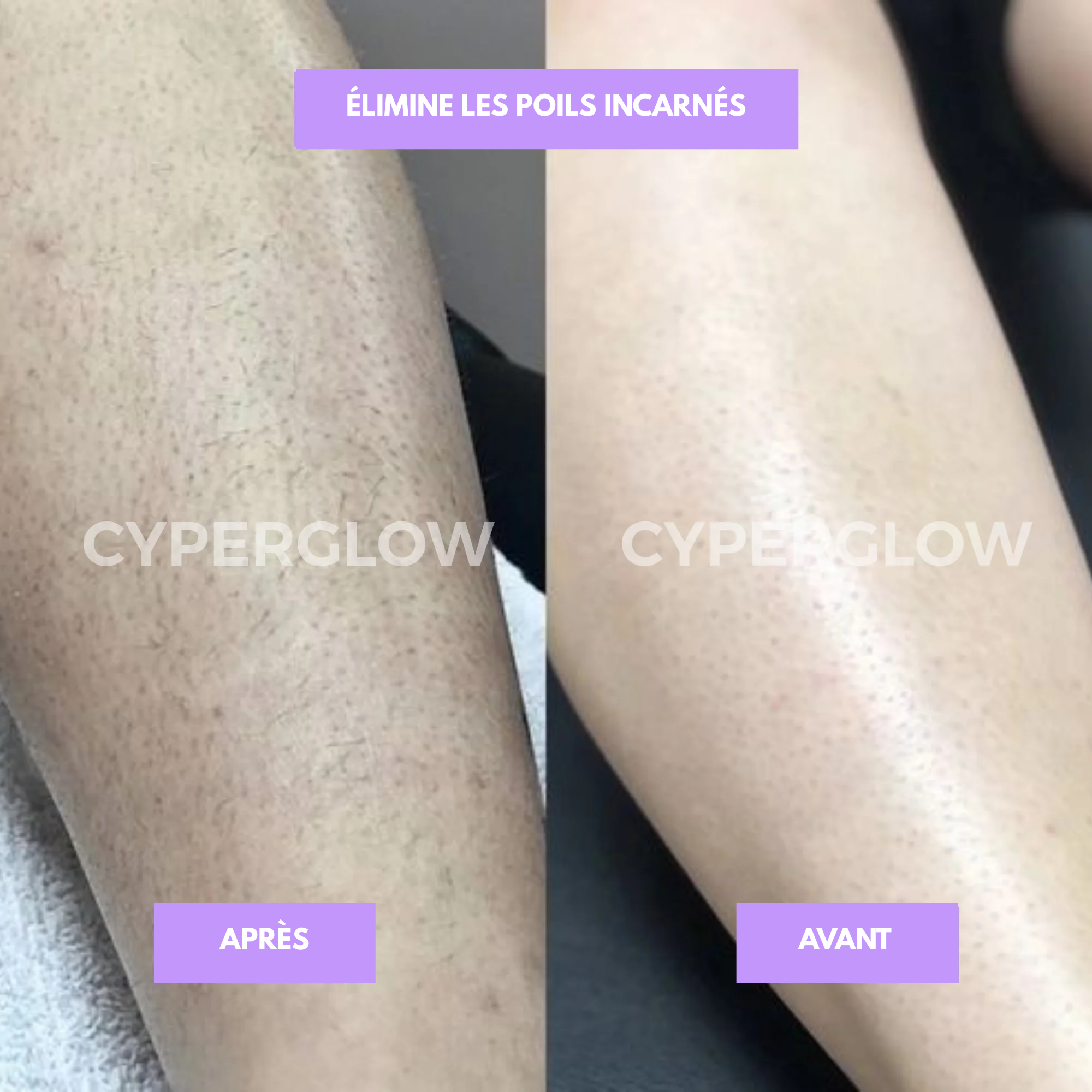 Cyperus - disparition définitve des poils ! RONEX