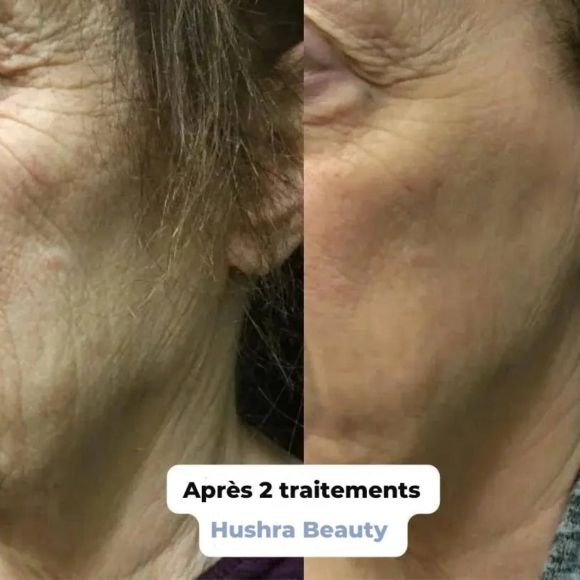 Micro infusion anti-rides