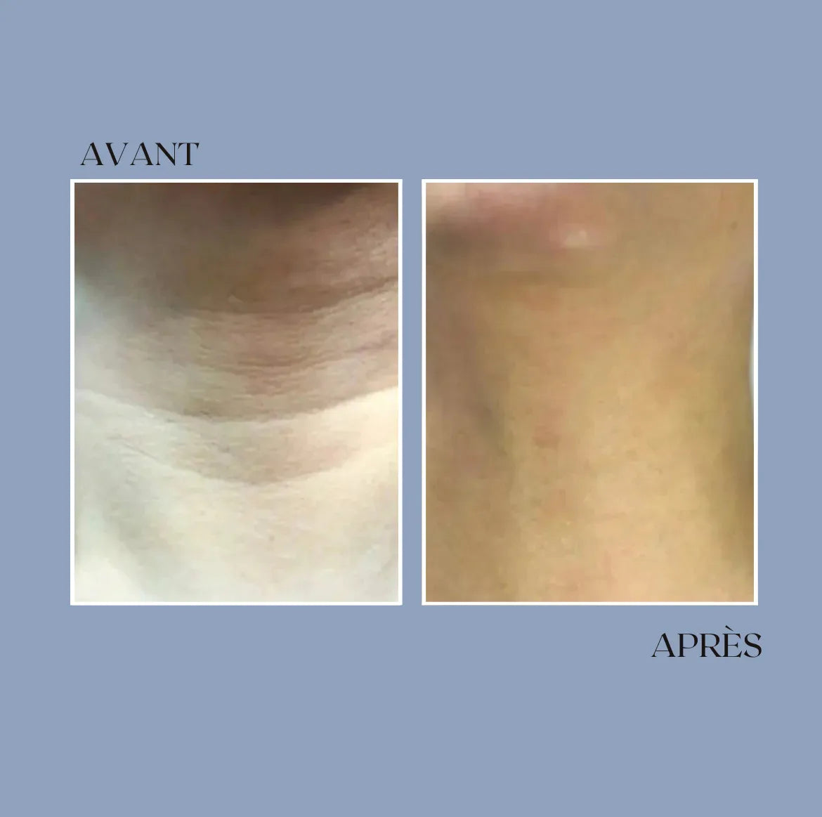 Micro infusion anti-rides