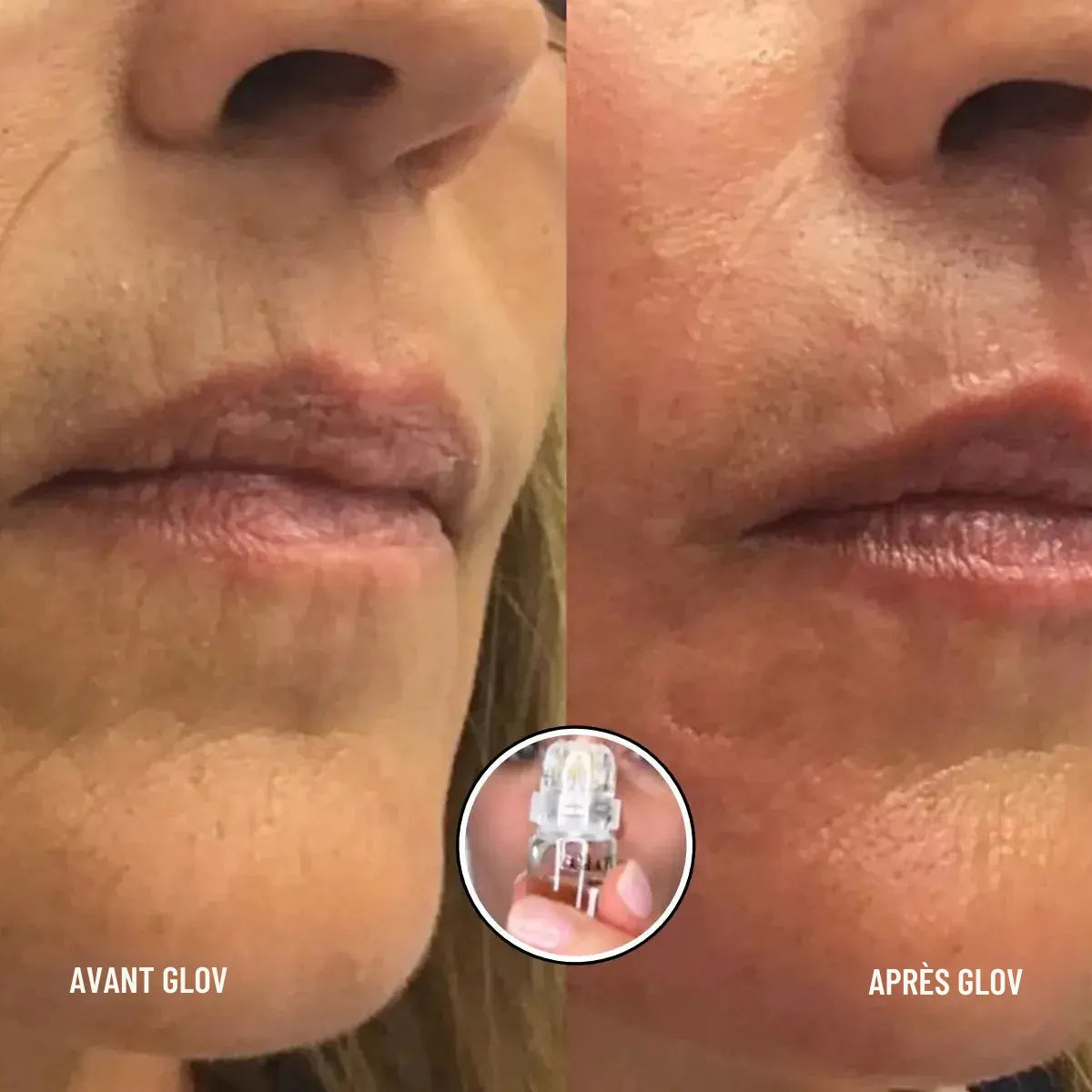 Micro infusion anti-rides