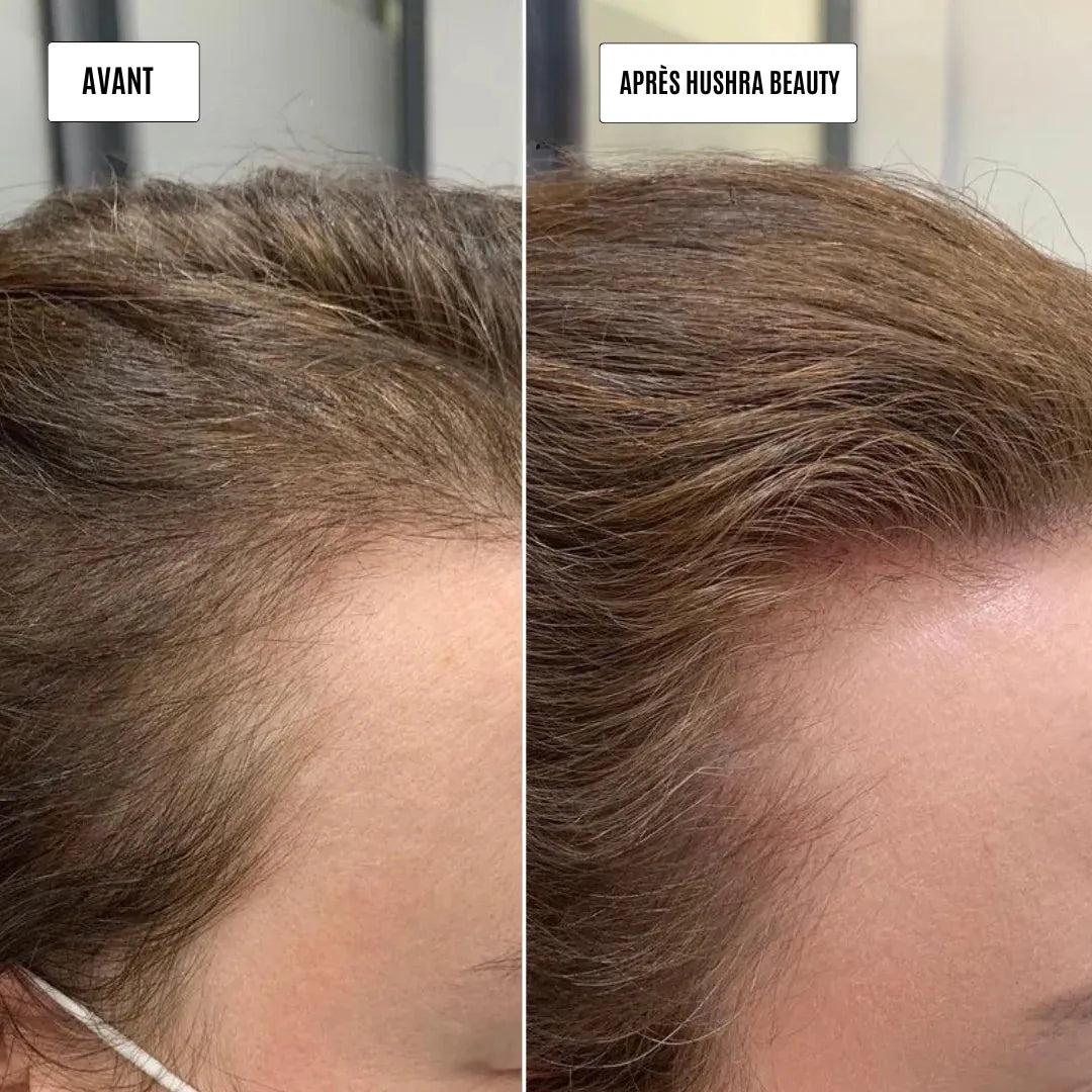 Micro infusion repousse cheveux