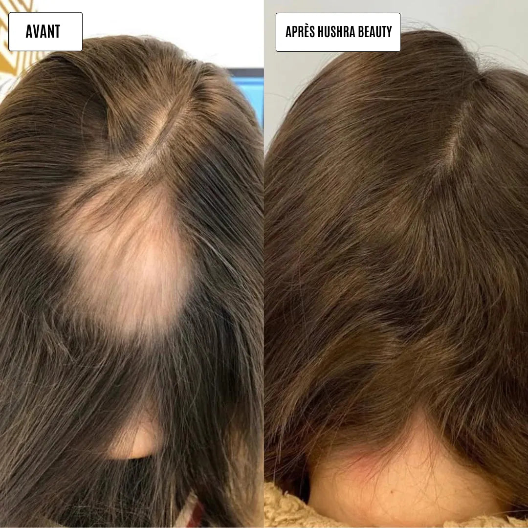 Micro infusion repousse cheveux