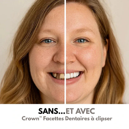 Hushra™ Facettes à clipser